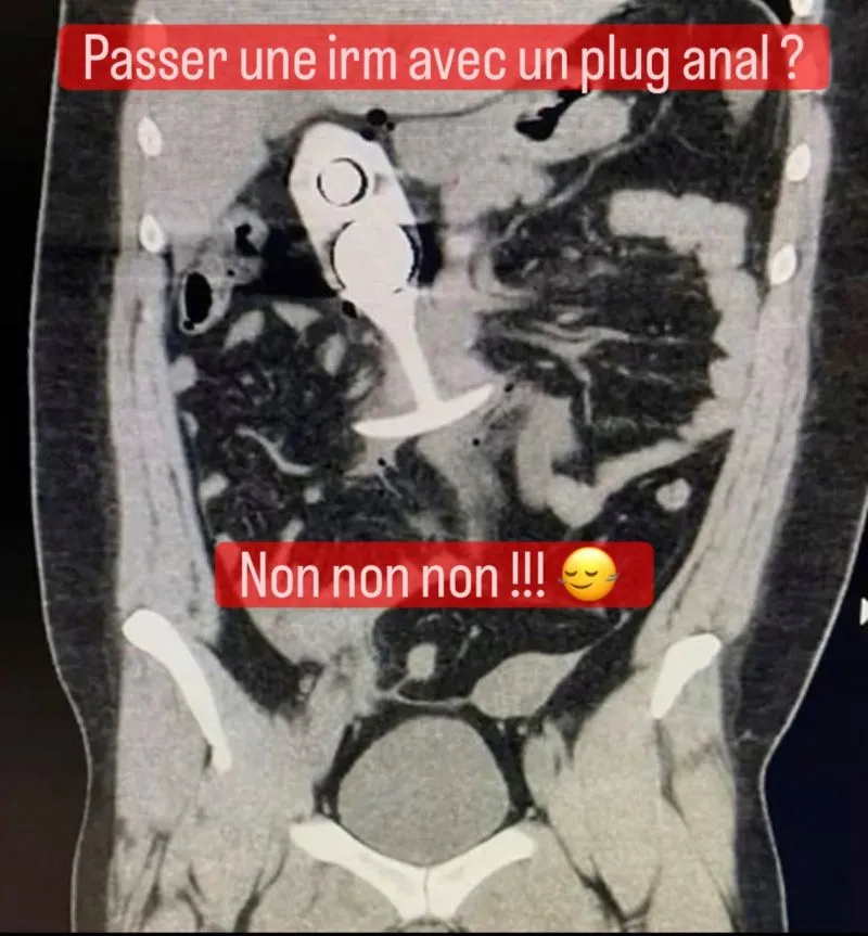 Illustration du post LinkedIn : ❗ Il est dangereux de passer une IRM avec un plug anal